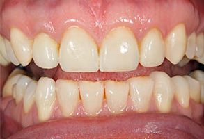 Before and After Teeth Whitening near Attleboro