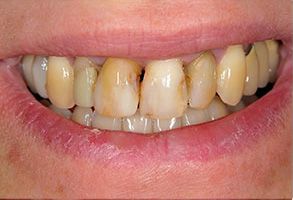 North Attleboro Before and After Dental Implants