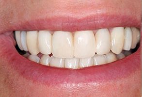 Before and After Dental Implants in North Attleboro