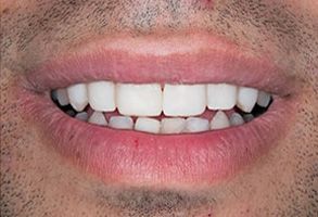 Before and After Invisalign near Plainville