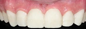 North Attleboro Before and After Dental Fillings