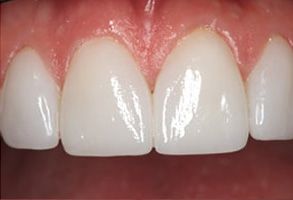 Before and After Dental Exam near Plainville
