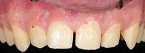 Before and After Dental Fillings in North Attleboro