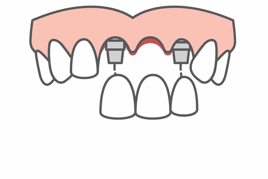 Bridge Implant Wphoto 3