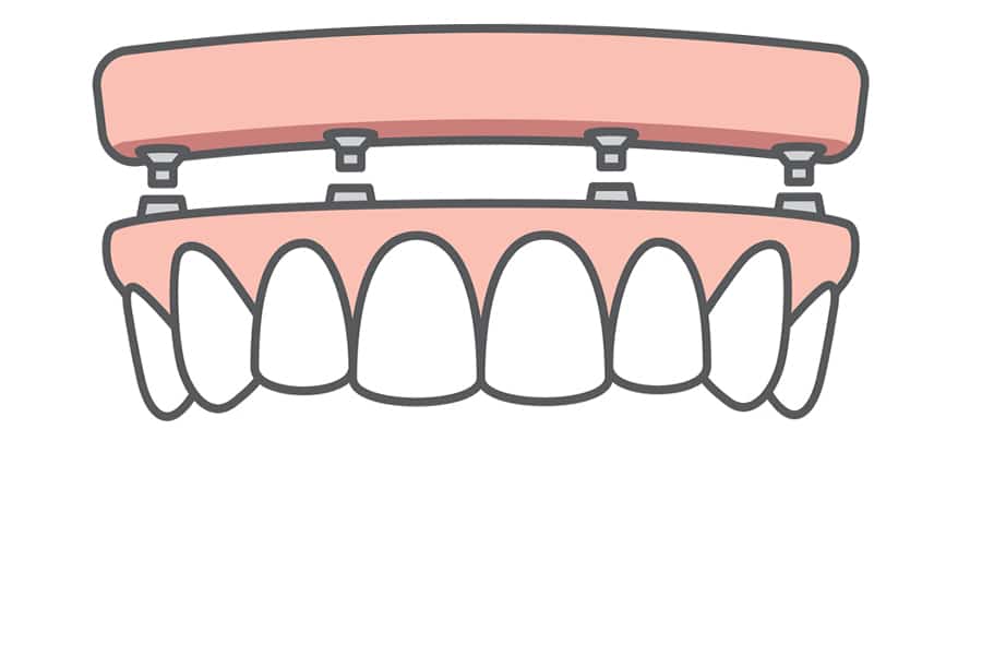 Full Arch Implant Wphoto 3