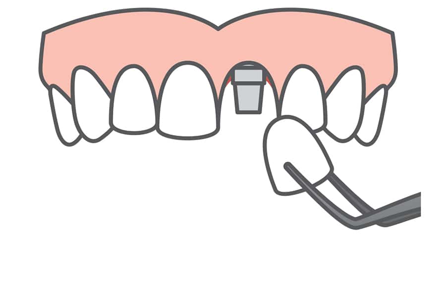 Single Implant Wphoto 3